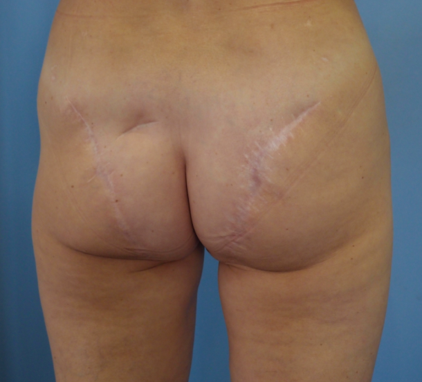 gluteal scars