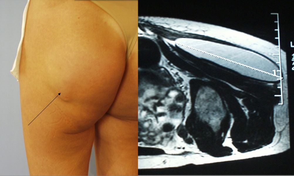 gluteal-implant-too-superficial