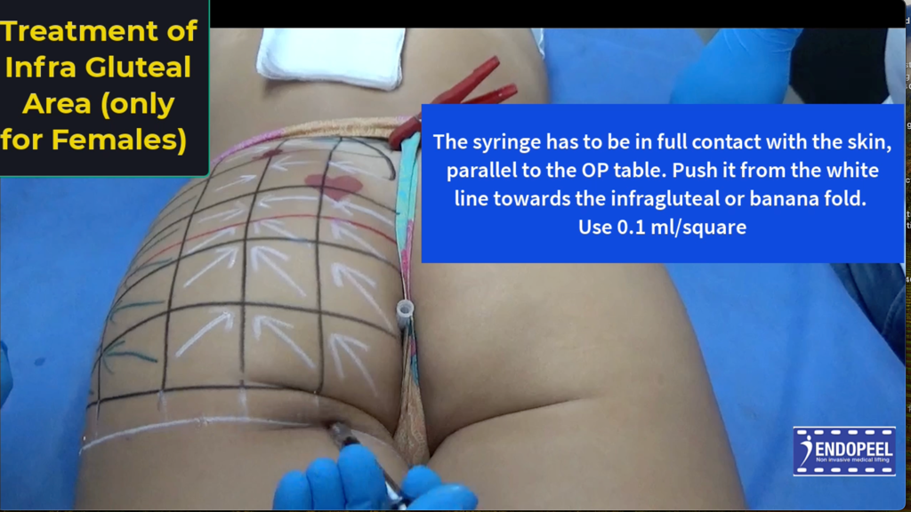 infra-gluteal-area-injection-step4