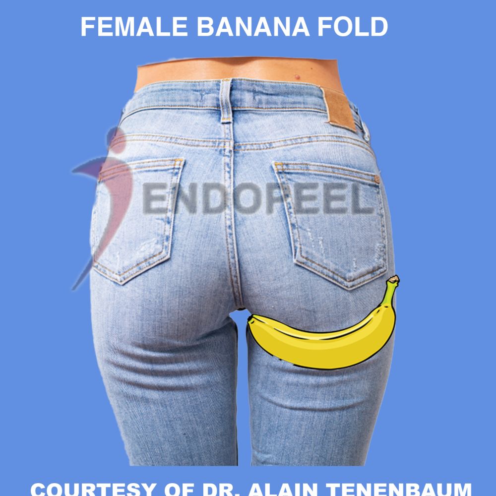 female banana fold