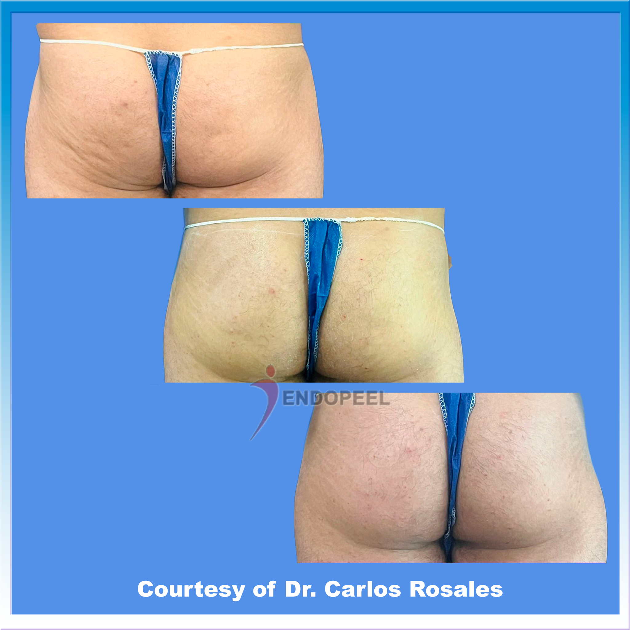 evolution of butts after endopeel treatment of a mature man