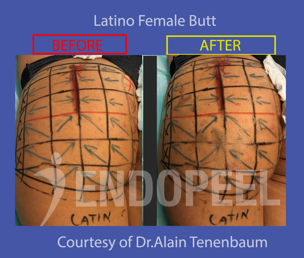before-after-latino-female-left-butt