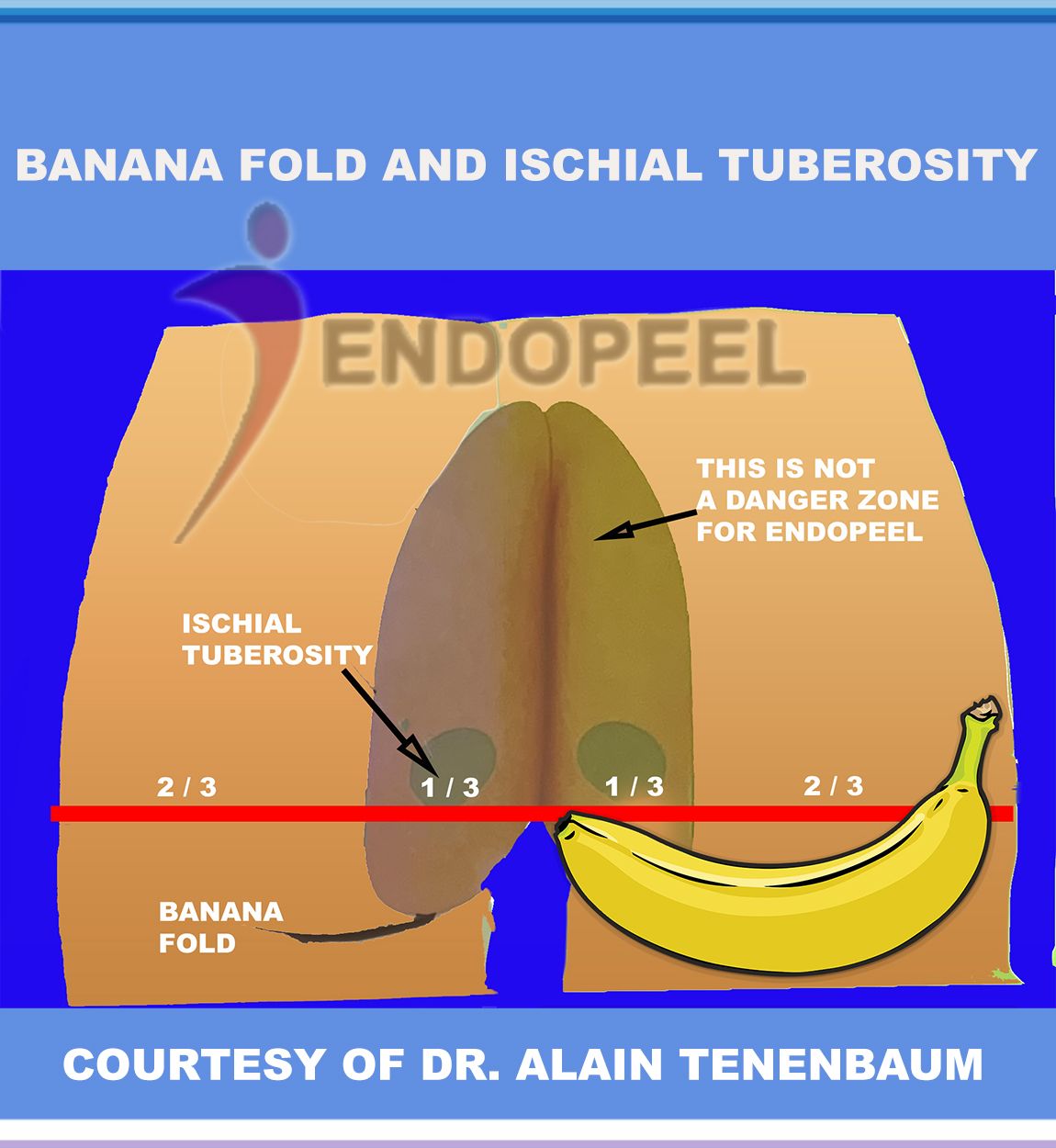 banana fold and ischial tuberosity