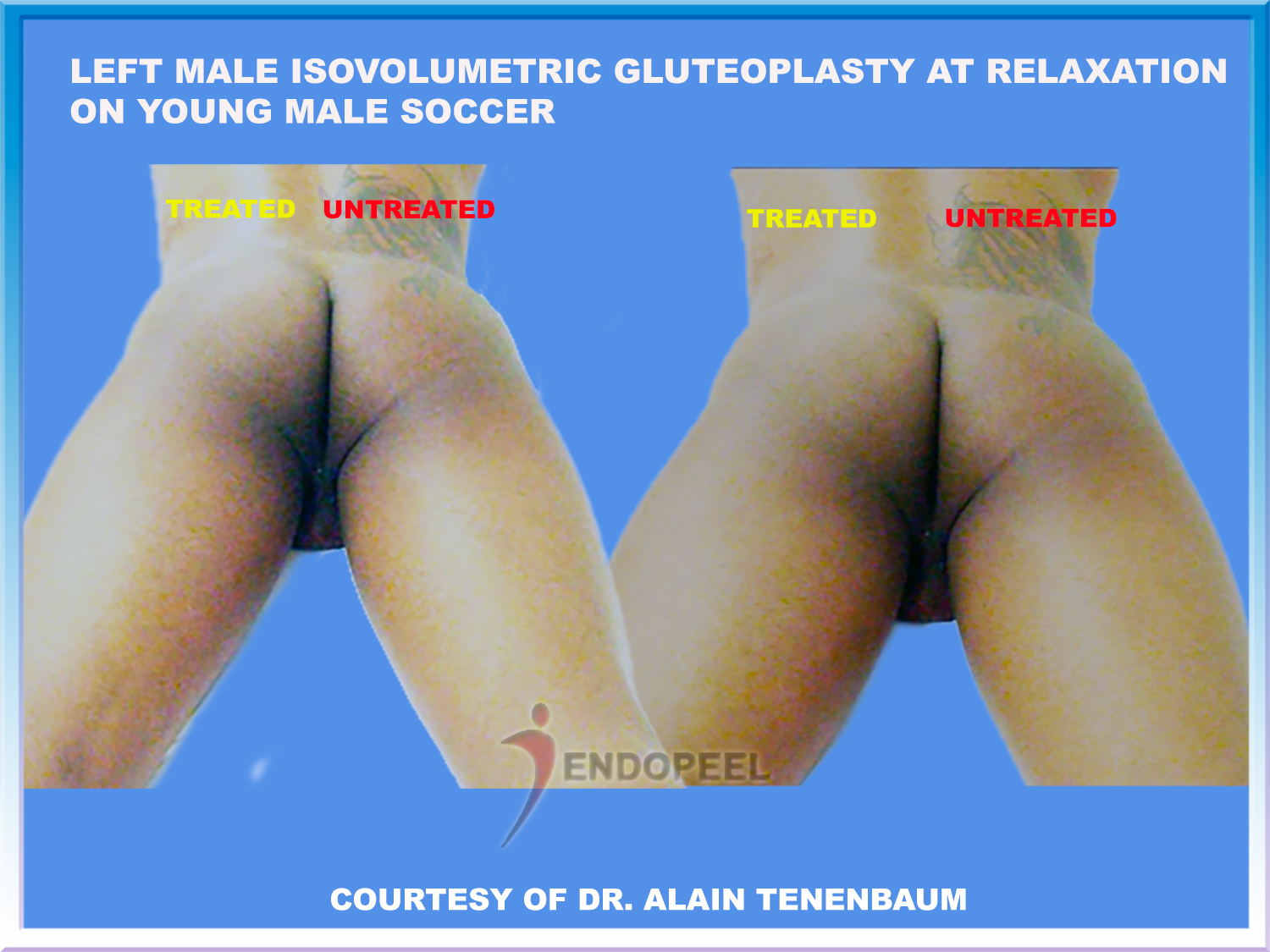 /L-sporty-male-gluteoplasty-relaxation
