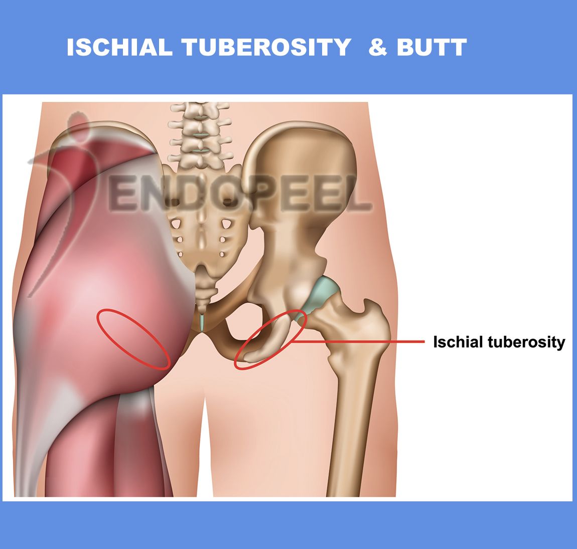 ischial-tuberosity