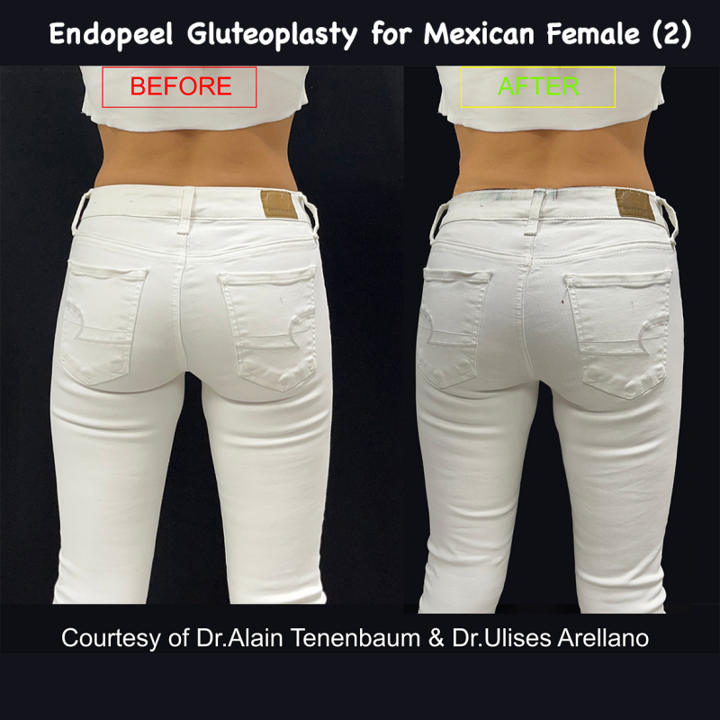endopeel gluteoplasty for young mexican woman