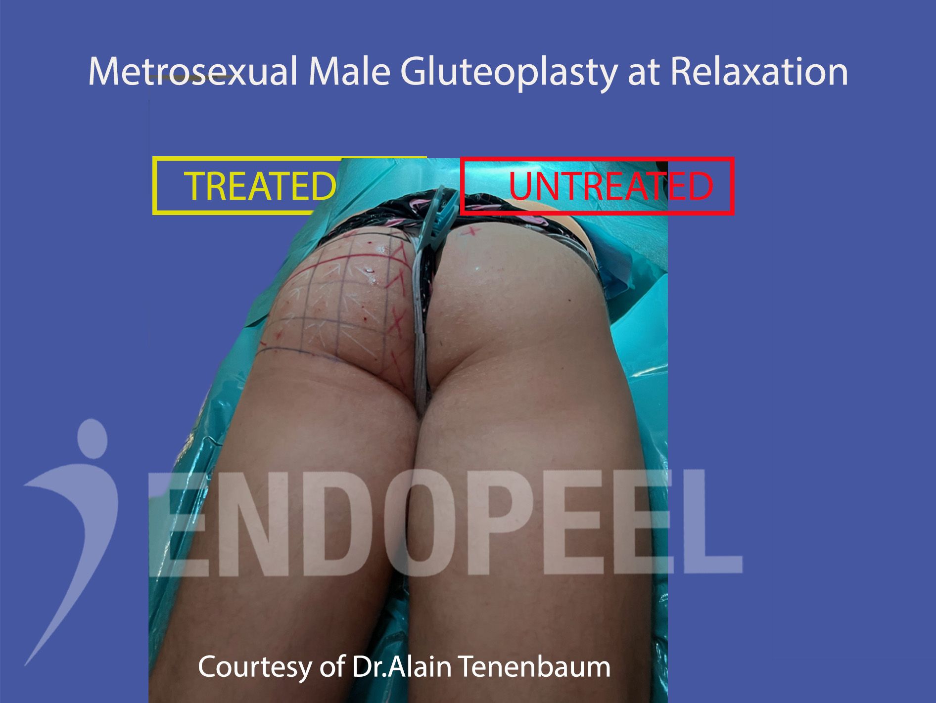 metrosexual-male-gluteoplasty-at-relaxation
