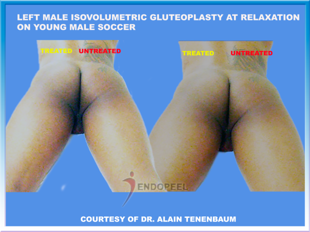 sporty male at relaxation : left gluteoplasty