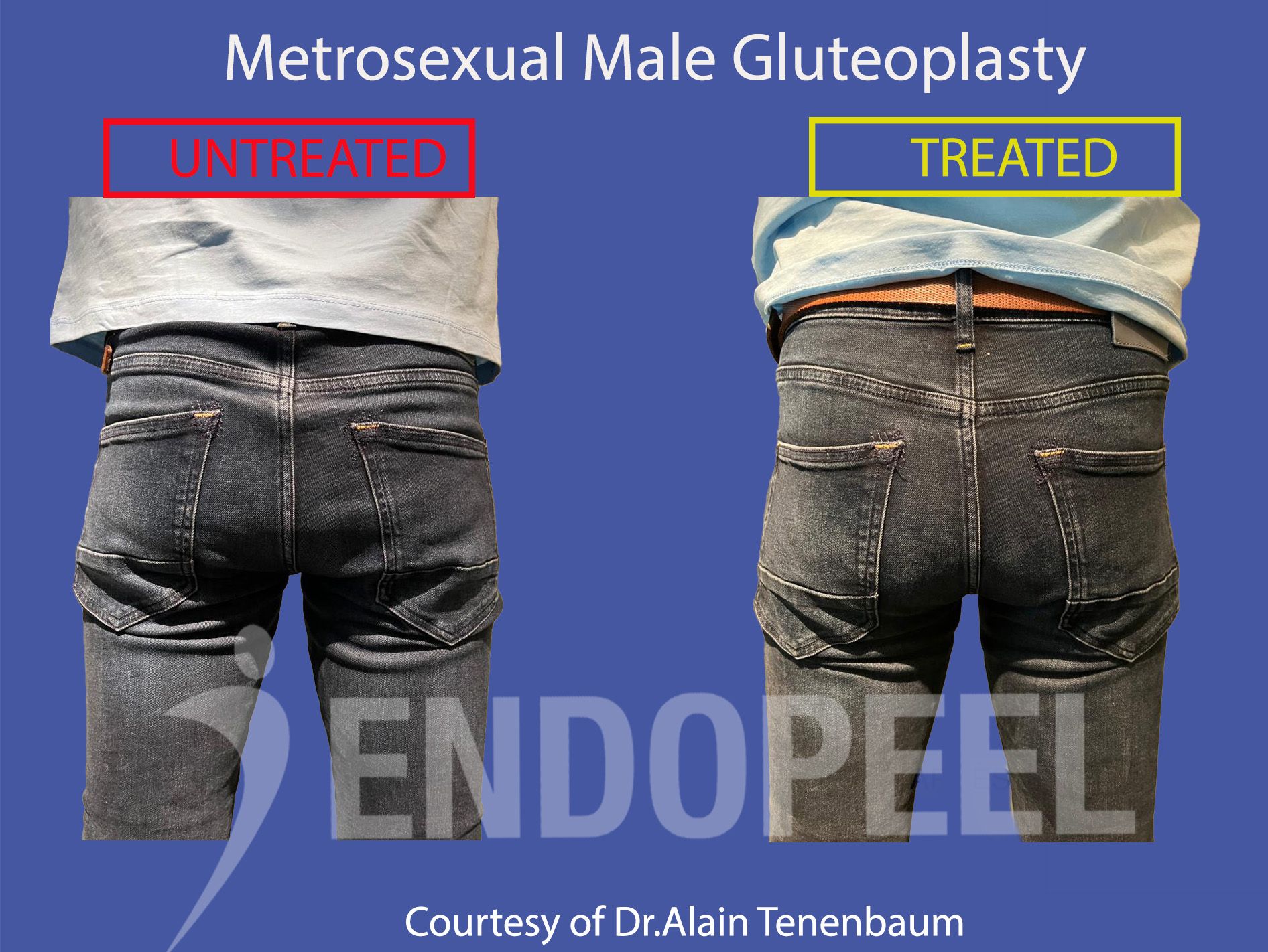 metrosexual-male-gluteoplasty
