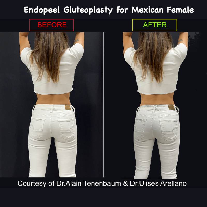 endopeel female mexican gluteoplasty