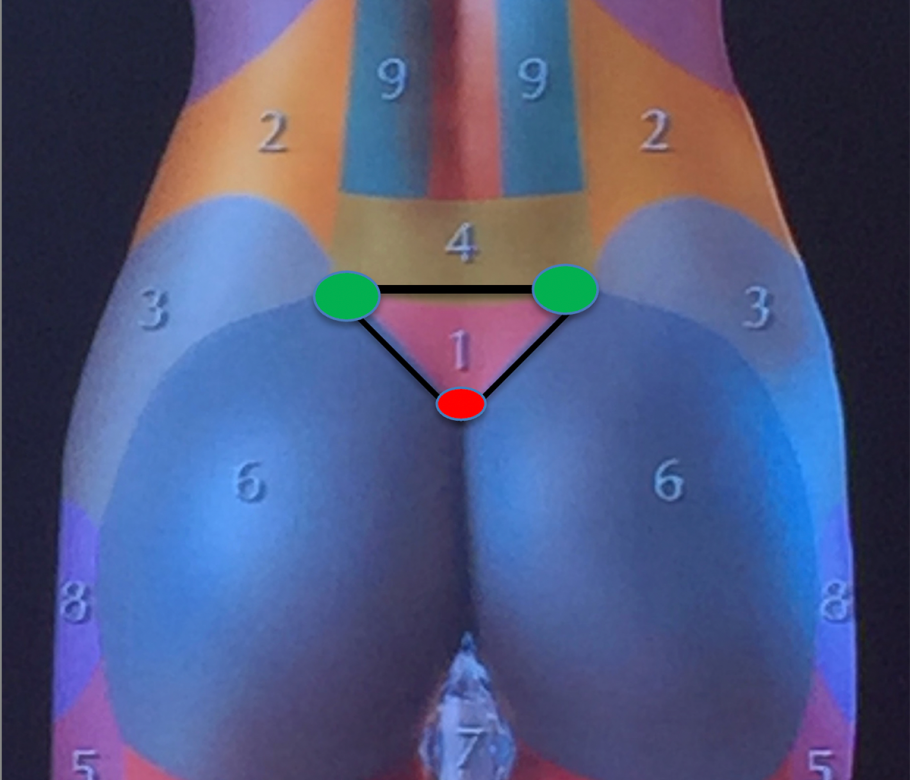 limits of the pre sacral triangle