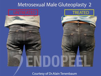 metrosexual men/metrosexual-male-gluteoplasty