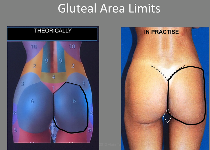 endopeel-gluteal-area-limits