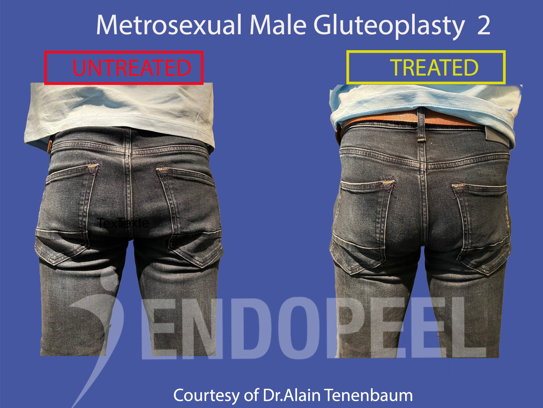 metrosexual-male-gluteoplasty2